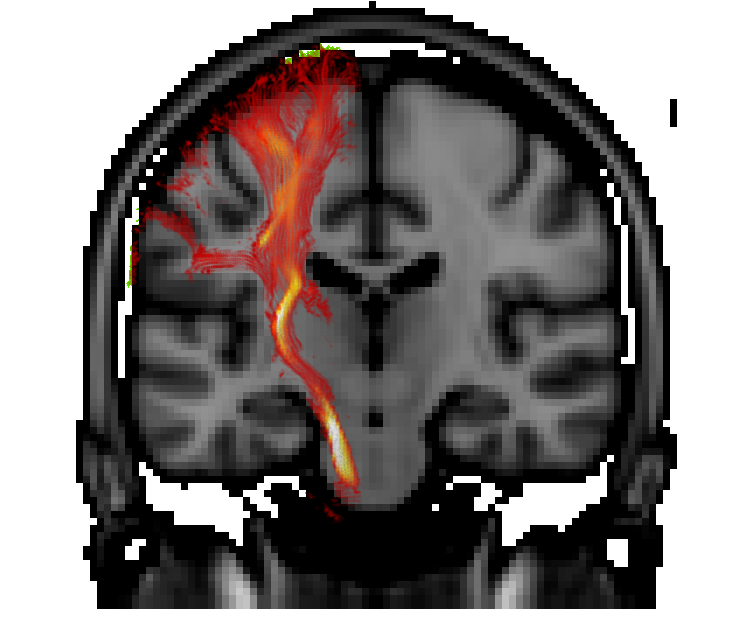 _images/overlays_tractogram1.png